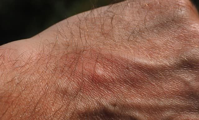 Tips And Remedies to Relive Skin Itching