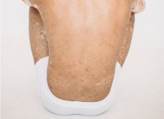 What is the Root Cause of Psoriasis?