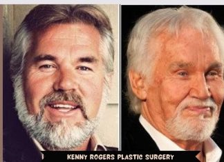 Kenny Rogers Plastic Surgery: What You Need to Know